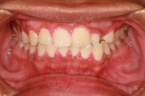 Gum swelling Inflammation of the gums