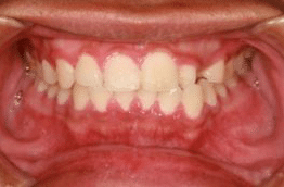 swelling of the gums