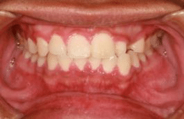 swelling of the gums