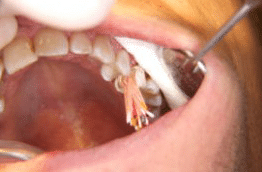 intense root canal