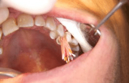 intense root canal