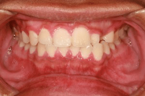 peridontal inflammation of the gums