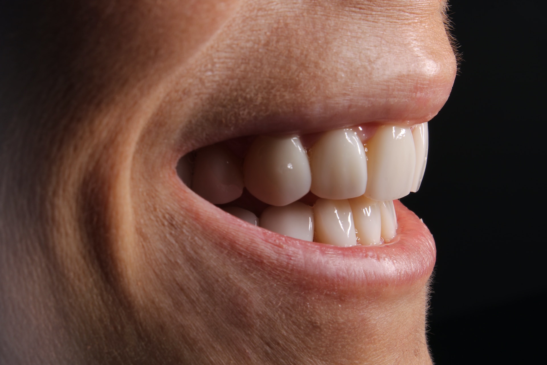 The Benefits Of Dental Veneers: Transform Your Smile Today